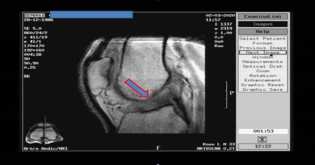  Povreda prednje ukrštene veze kolena mr imaging 